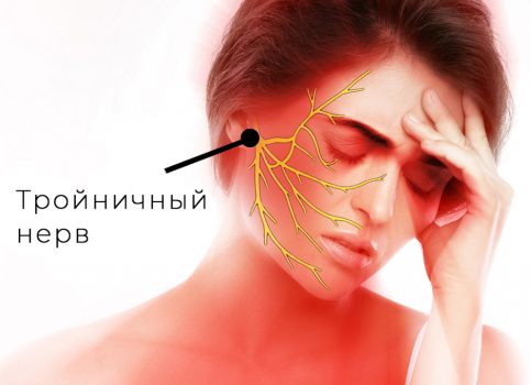 Невралгия тройничного нерва