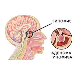Психосоматика Аденома гипофиза