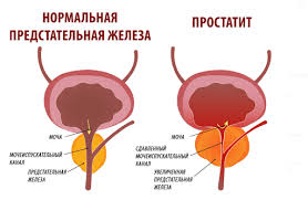 Психосоматика Аденома простаты