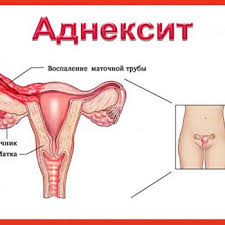 Психосоматика аднексита