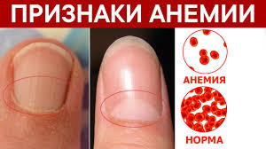 Психосоматика Анемия