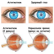 Психосоматика Астигматизм