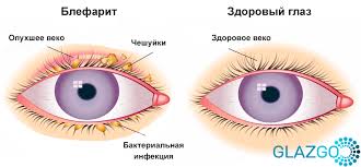 Психосоматика Блефарит