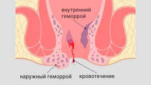 Психосоматика Боль в заднем проходе