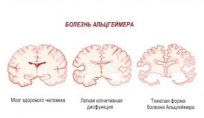 Психосоматика Болезнь Альцгеймера