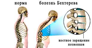 Психосоматика Болезни Бехтерева