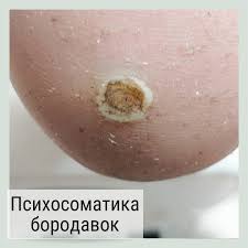 Психосоматика Бородавки