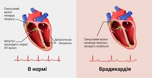 Психосоматика Брадикардия