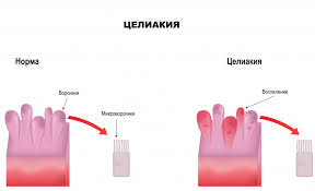 Психосоматика Целиакия