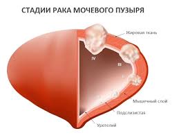Психосоматика и рак мочевого пузыря