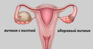 Психосоматика Киста яичника