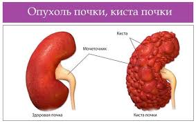 Психосоматика Киста почки