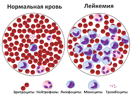 Психосоматика Лейкемия