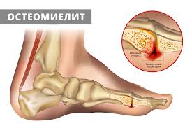 Психосоматика Остеомиелит