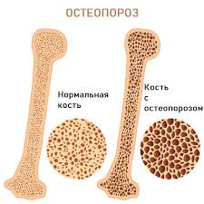 Психосоматика Остеопороз