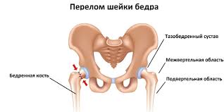 Психосоматика Перелом шейки бедра