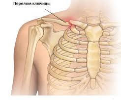 Психосоматика перелома ключицы