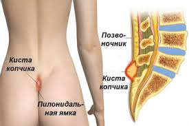 Психосоматика перелома копчика