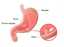 Психосоматика Полипы желудка