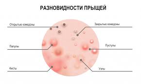 Психосоматика Прыщи