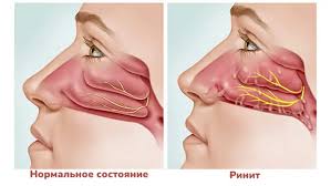 Психосоматика Ринит