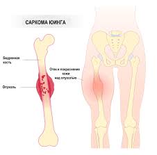 Психосоматика Саркома
