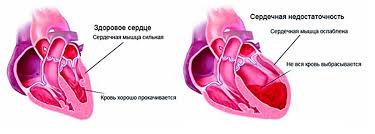Психосоматика Сердечная недостаточность