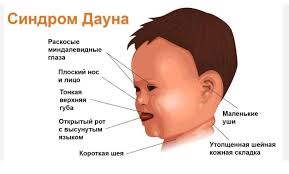 Психосоматика Синдрома Дауна