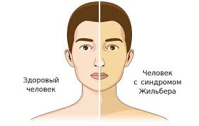 Психосоматика Синдрома Жильбера
