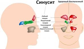 Психосоматика Синусита