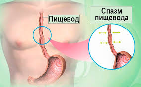 Психосоматика Спазма Пищевода