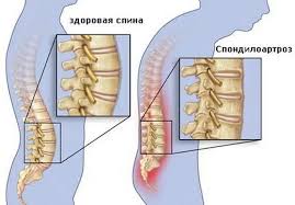 Психосоматика Спондилоартроза