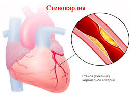 Психосоматика Стенокардии