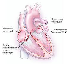 Психосоматика Тахикардии