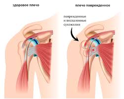 Психосоматика Тендинита