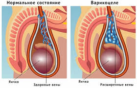 Психосоматика Варикоцеле