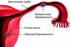 Психосоматика Внематочной беременности