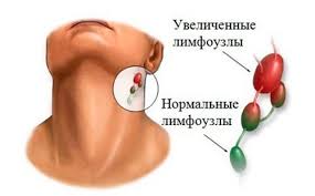 Психосоматика Воспаления лимфоузлов