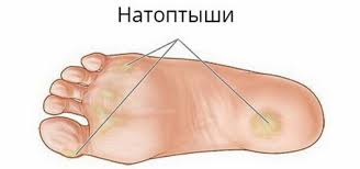 Психосоматика Натоптышей