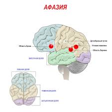 Психосоматика Афазия