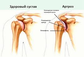 Психосоматика Артроз плечевого сустава