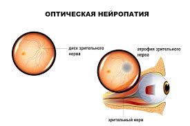 Психосоматика Атрофия зрительного нерва