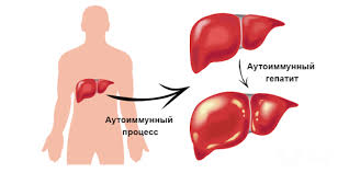 Психосоматика Аутоиммунный гепатит