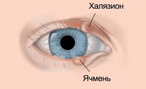 Психосоматика Халязиона