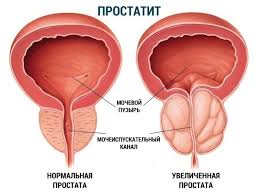 Психосоматика Хронический простатит