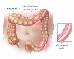Психосоматика и Синдром раздраженного кишечника