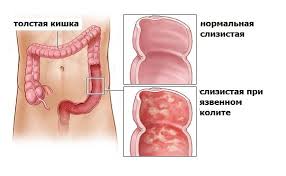 Психосоматика Язвенный колит