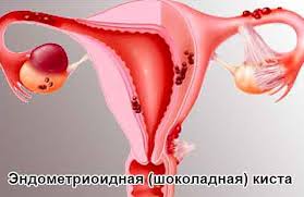 Психосоматика Эндометриоидной кисты яичника