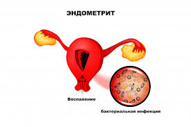 Психосоматика Эндометрита