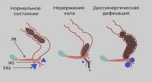 Психосоматика Энкопреза